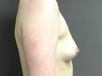 Side Before