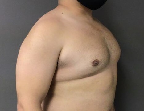Oblique After