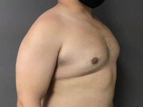 Oblique After