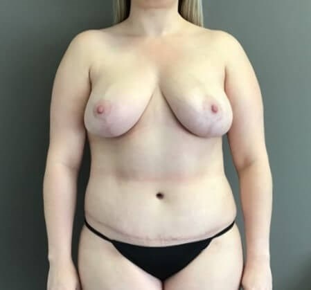 Anterior After