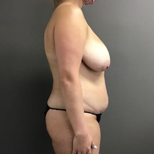 Side Before