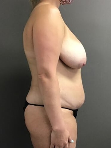 Side Before