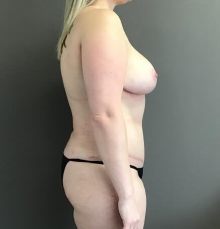 Side After