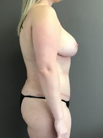 Side After
