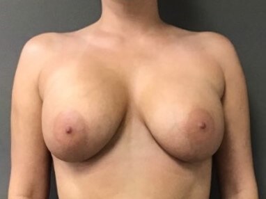 Anterior After