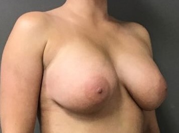 Oblique After