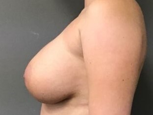 Side After