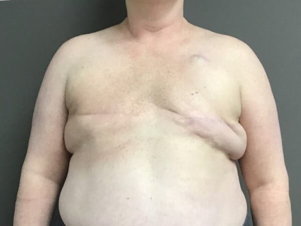 Anterior Before