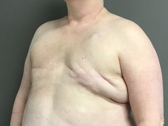 Oblique Before