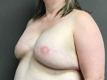 Oblique After