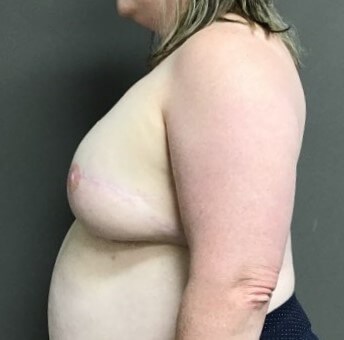 Side After