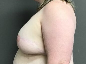 Side After