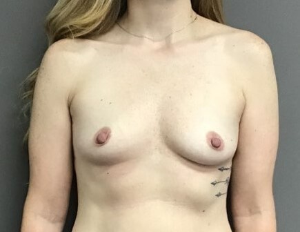 Anterior Before