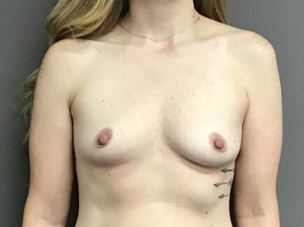 Anterior Before