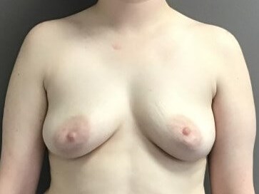 Anterior Before
