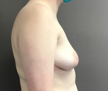 Side Before