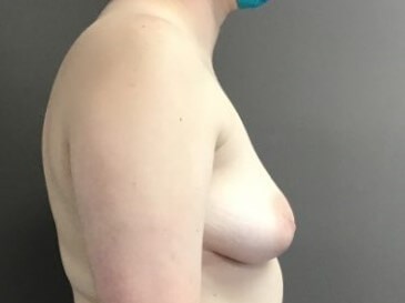 Side Before