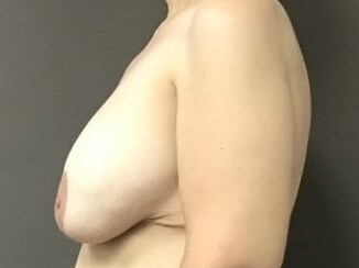 Side Before
