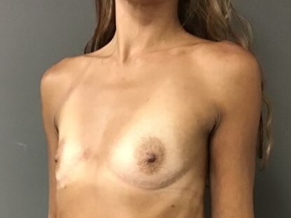 Oblique Before