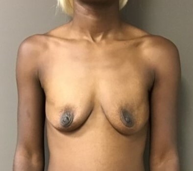 Anterior Before