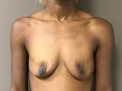 Anterior Before