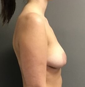 Side Before