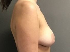 Side Before