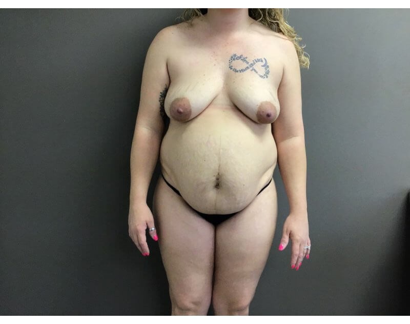Anterior Before