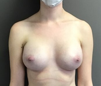 Anterior After