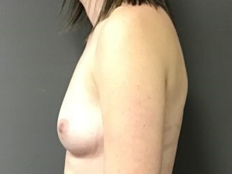 Side Before