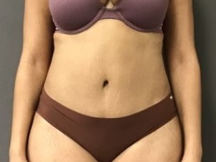 Anterior After