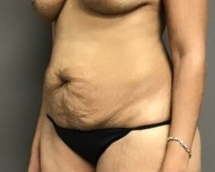 Oblique Before