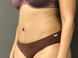 Oblique After