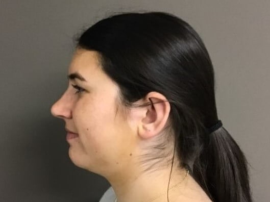 Side After