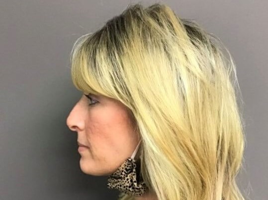Side Before