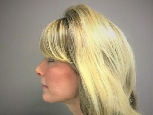 Side After