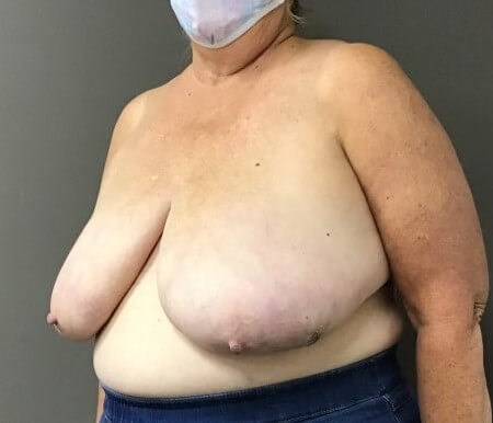 Oblique Before