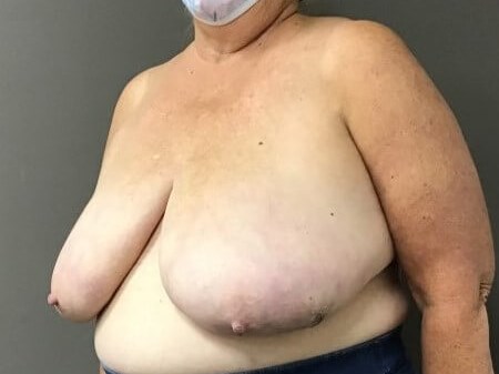 Oblique Before