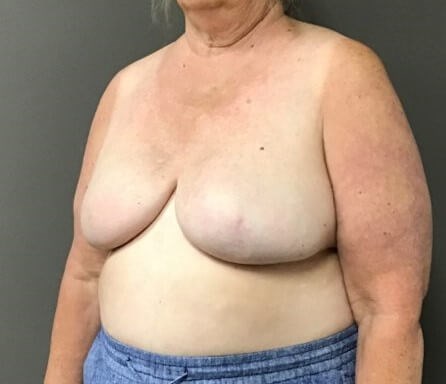 Oblique After