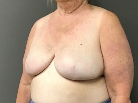 Oblique After