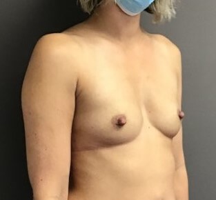 Oblique Before