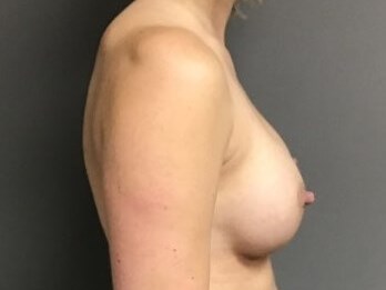 Side After