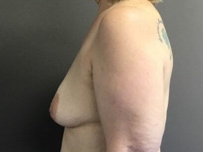 Side Before