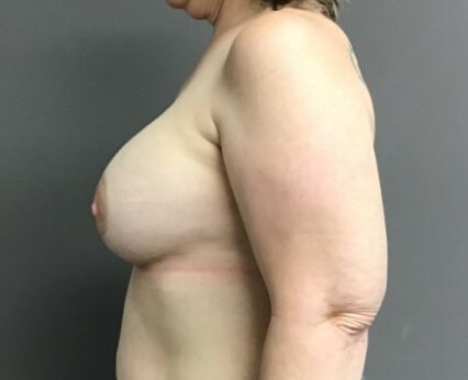 Side After