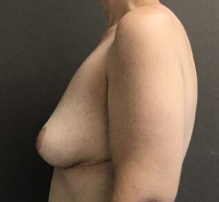 Side After