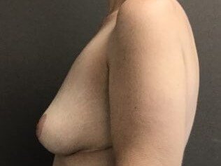 Side After