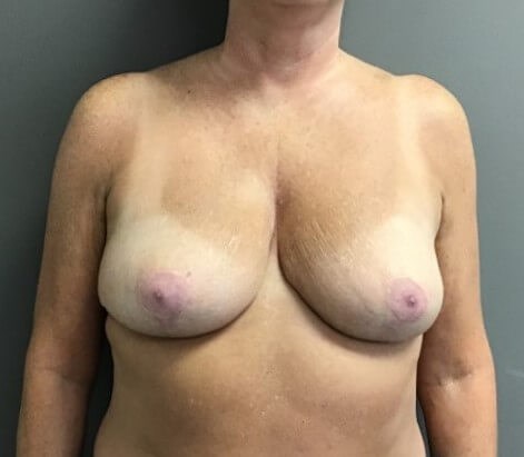 Anterior After