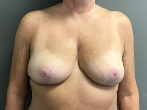 Anterior After