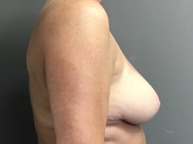 Side After