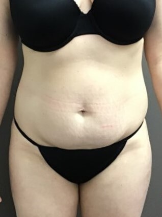 Anterior Before